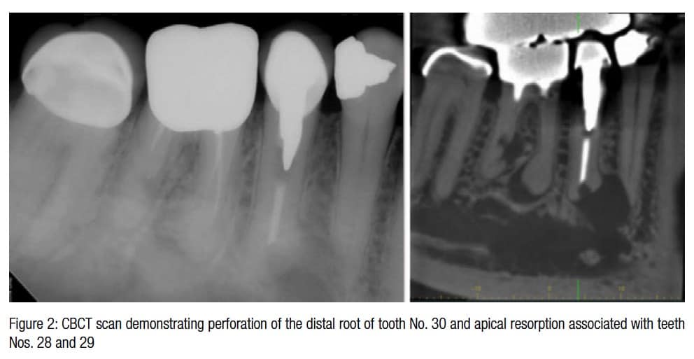3d imaging cbct scan endodontic practice bruno tooth