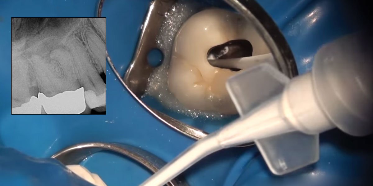 Using a bioceramic sealer in conjunction with vertical condensation