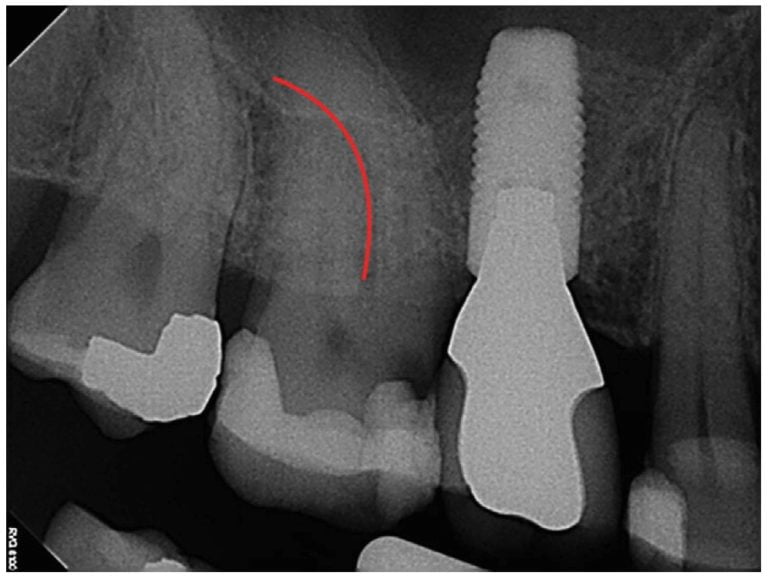 Endodontic insight The Glide Path — laying the groundwork for proper