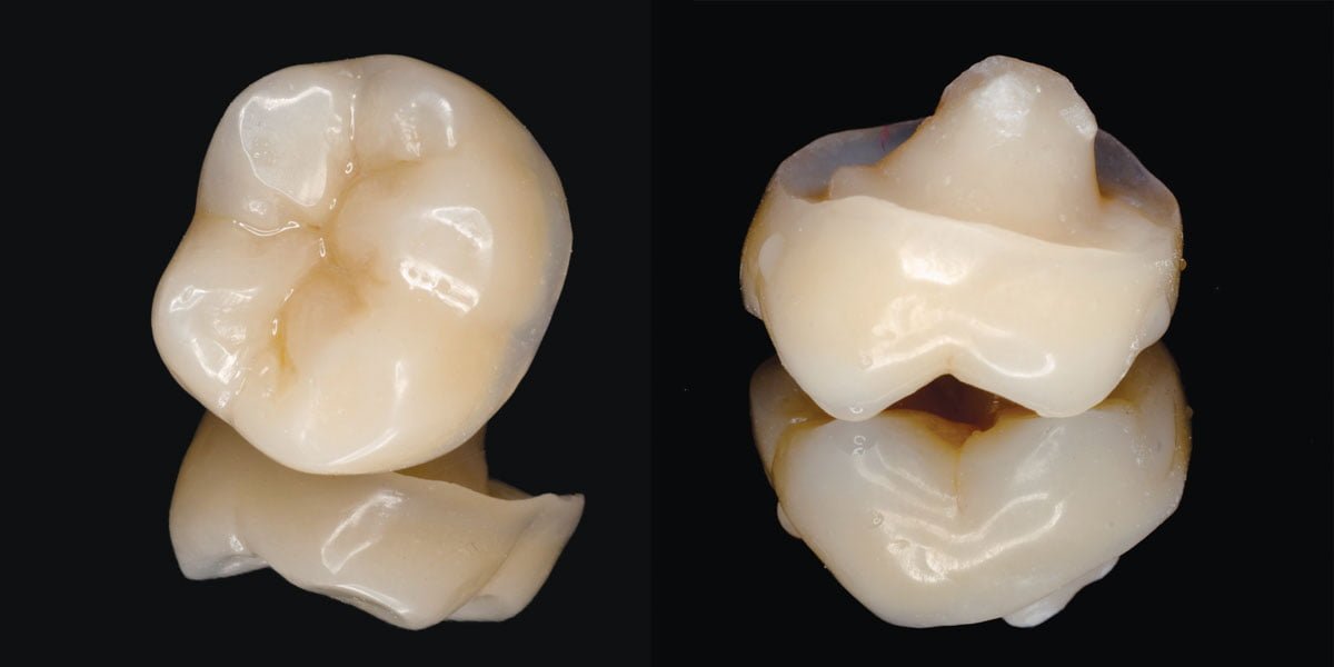 Reconstruction of a tooth with composite endocrown following root canal ...