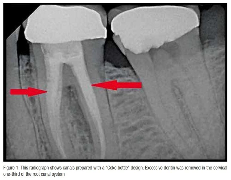 Endodontic CE Article CE Article An endodontic restorative update