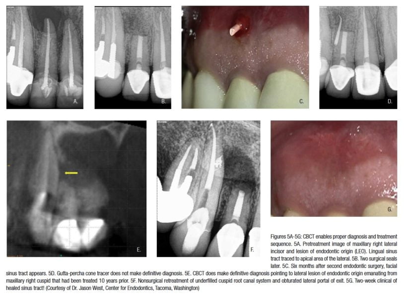 CBCT 3D imaging: the next endodontic frontier of the great endodontist ...