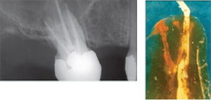 Figure 1C: Failing endodontic maxillary molar with externally stripped DB foramen. MB was internally blocked and then externally transported. Figure 1D: Endodontic failure demonstrates probable original POE penetrated with red Pelikan ink while the guttapercha obturation, though probably iatrogenic, is actually an overfill in that the POE is sealed, and there is excess obturation material.