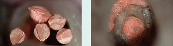 Figure 3E: Five conefits are made to validate desired shaping. Figure 3F: Endodontic backpack completed prior to access seal.