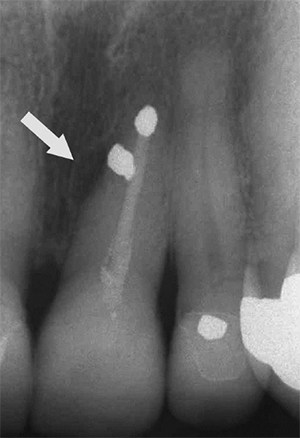 Figure 1: Pretreatment. 1988 pretreatment radiograph of previous nonsurgical endodontic treatment followed by surgical retreatment. Arrow points to apparent lateral lesion of endodontic origin.
