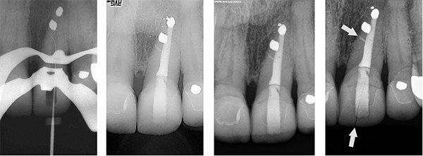Figure 2: Nonsurgical retreatment. Note No. 6 manual file sliding into lateral canal approximately 2 mm incisal to lateral canal surgical seal attempt. Figure 3: Posttreatment. Note lateral canal obturated at site of cleaned lateral canal seen in Figure 2. Figure 4: Twenty-year posttreatment. Lamina dura and attachment apparatus show sustained healing of lateral lesion of endodontic origin (LEO). Figure 5: 2010 posttreatment. While continued endodontic healing of lateral LEO continues at the lateral canal seal site (arrow), the patient had fractured the crown (arrow).