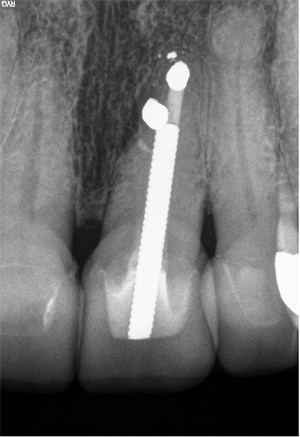 Figure 6: Twenty-five-year posttreatment. Note continued health of lateral lamina dura adjacent to sealed lateral canal and robust post placement, foundation, and new crown.