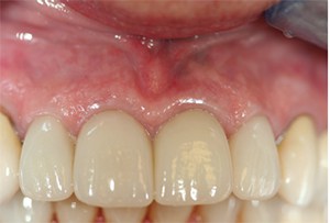 Figure 7: Clinical. Image reveals favorable esthetic match with adjacent central incisor and long-term contribution to an attractive smile.