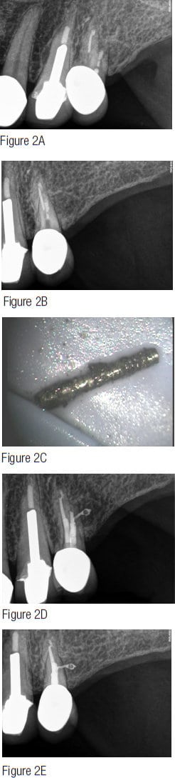 Figures 2A-2E: Anatomy and reputation. Are you the “go to” endodontic resource when the treatment is challenging, or the success of the result is critical? 2A. Pretreatment image of symptomatic maxillary second premolar with two strikes against it: 1) Nonsurgical and surgical Endodontic Seal already attempted. 2) Compromised crown/root ratio and recently restored with post, foundation, and crown. Most dentists would treatment plan removal and replacement with implant, but since not fractured, symptoms were simply due to undersealed root canal system. Skilled nonsurgical disassembly and Endodontic Seal attempt should be in the patient’s best biologic and financial interest. Do you have the confidence, the skill, and the reputation to realistically offer nonsurgical endodontic option? 2B. Image of post removed. 2C. Post removed. 2D. Posttreatment image demonstrating significant distal POE sealed. 2E. Eight-year posttreatment image demonstrating rejuvenation of the lamina dura and periodontal ligament. The original restorative has structurally remained intact and the tooth is functioning normally