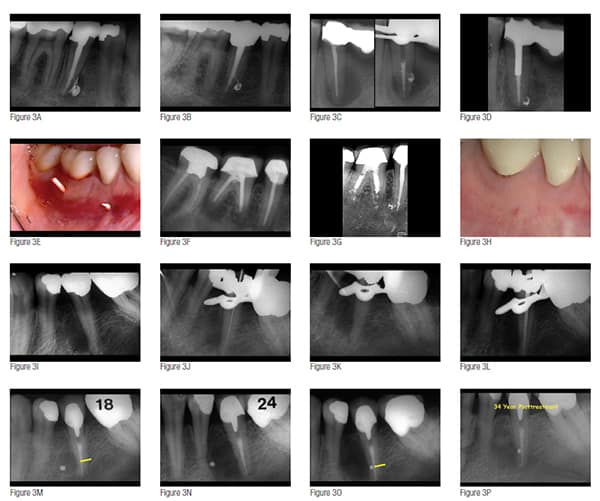 Figures 3A-3P: Anatomy and longevity. Can you tell your patient that your endodontic treatment can predictably last them the rest of their lives? 3A. Posttreatment image of mandibular right second premolar classic nonsurgical warm gutta-percha technique obturation. 3B. 32-year posttreament image. 3C. Pretreatment and downpack image of mandibular left FPD abutment. 3D. 29-year posttreatment image. 3E. Gutta-percha traced sinus tracts from mandibular molar and premolar of previous nonsurgical followed by surgical underfilled root canal systems. 3F. Pretreatment image. 3G. 27-year posttreatment image. 3H. 27-year posttreatment clinical with no sinus tracts. 3I. Pretreatment of mandibular left second premolar with lateral LEO. 3J. First instrument to radiographic terminus. 3K. Instrument following in and through distal lateral POE. 3L. Conefit. 3M. 18-month posttreatment with arrow pointing to lateral POE position. 3N. 24-month posttreatment revealing increase in lateral LEO size increase. 3O. Post-surgical retreatment image of amalgam surgically sealing lateral POE (arrow). 3P. 34-year posttreatment image