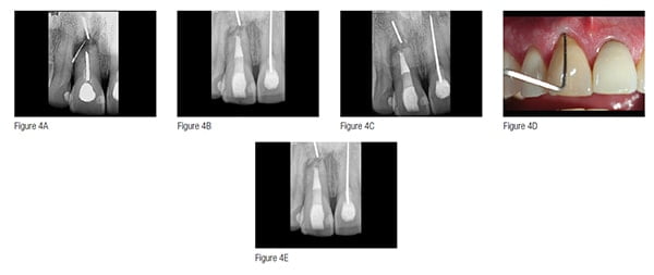 Figures 4A-4E: Anatomy and because. Sometimes we do something because it is there; because we want to “organize and measure the best of our ‘energies and skills.’” 4A. Pretreatment image of seemingly hopeless tooth with gutta-percha cone tracing sinus tract to resorbed root end with sectioned silver cone. 4B. “Because it is there and possible,” patient elected to attempt nonsurgical endodontic retreatment. He did not want an implant. Image shows pack film. 4C. Same pack film placed more apically in order to show there was no apparent radiolucency around section silver cone in apical root remnant, and treatment plan was to leave the root tip unless future evidence of pathology. 4D. Two- year posttreatment with healthy gingival probing and no sinus tract. Patient has elected to proceed with connective tissue graft in order to improve gingival levels. 4E. Two-year posttreatment image with healthy attachment apparatus. Retreatment of adjacent maxillary central is scheduled with safe “walking” bleach intended to improve gingival root discoloration