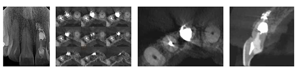 Figure 17: Post-op radiograph; Figure 18: Post-op axial slices; Figure 19: Post-op axial slice; Figure 20: Post-op sagittal slice