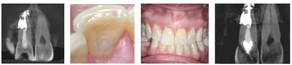 Figure 21: Post-op coronal slice; Figure 22: Post-op clinical image composite restoration; Figure 23: Post-op clinical image; Figure 24: Measuring the depth of the composite resin