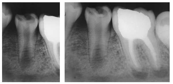 Figures 1A-1B: 1A. Preoperative radiograph showing carious lesion and the immature root. 1B. Postoperative radiograph after pulp capping with MTA