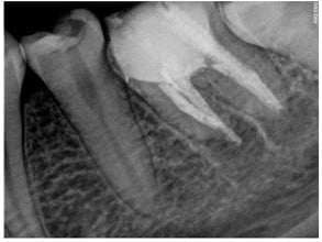 Apexogenesis and apexification with mineral trioxide aggregate (MTA): a ...
