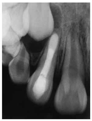 Figure 6: Postoperative radiograph showing the MTA plug, full canal filled, and access cavity restoration