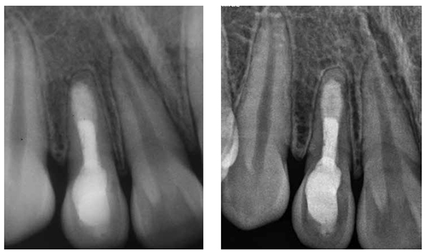 Figures 7A-7B: Radiographs obtained at follow-up visits after 5 years (Figure 7A) and 7 years 5 months (Figure 7B) revealing treatment success