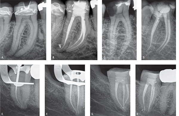 Figure 2: From Fear to Fun. 2A-2B. Pretreatment and posttreatment of shaped canal in my ProTaper Universal (PTU) era. Note that a PTU F1 was never “followed” to length due to my fear of file breakage. I only shaped apically with S1 and then S2. 2C-2D. Treatment result from my PTG era. PTG F1 was confidently “followed” to length in each of the four molar canals, followed by conefit, and then easy obturation. The fear of breakage and the energy used up by that fear never did not cross my mind nor does it ever anymore. The PTG Finishers have clinically proven to me that they are reliable and safe. They easily and predictably crawl along smooth dentin walls with the greatest of ease. 2E. Abrupt apical distal hook of mandibular second molar followed by PTG S1. Preservation of portal of exit (POE) in a severe apical curve is one of endodontic’s biggest technical challenges. 2F. Distal conefit follows shaped F1 apical curve. 2G-2H. Oblique and perpendicular posttreatment images further validating no internal or external transportation of root canal system including last two millimeters of the distal canal