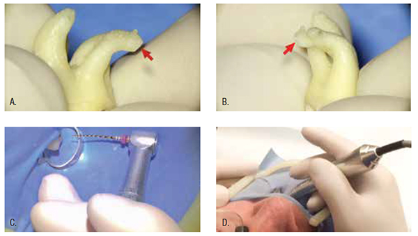 Figure 3: How to hold the Handpiece for Shaper Brushing/Following and Finisher Following/Brushing? 3A. PTG test tooth: Double “S” turn of maxillary molar DB canal. Canal makes 90 degree turn to the distal (right). 3B. Canal simultaneously turns to the buccal in another 90 degree turn. Test canal is therefore characterized by two 90 degree “S” turns in two different dimensions! 3C. For maxillary teeth, hold PTG handpiece (any electric handpiece at 300 rpm and maximum torque) as if it were a cigar between index and middle finger in order to prevent directing and pushing or pecking with index finger. The progressive geometries of PTG combined with the simple weight of the electric handpiece are sufficient to Brush/Follow as demonstrated using PTG S1. No pushing is required or desired. 3D. For mandibular teeth, the handpiece can be cradled by the thumb on one side and the index and middle finger on the other side. Then once again preventing the dangerous directing or pushing of the index finger