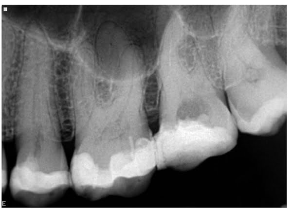 Figure 1: Tooth No. 26 appears to be moderately heavily filled but has a very sclerosed pulp chamber, indicating long-term insult to the pulp