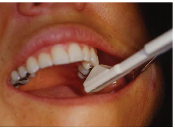 Figure 2: The Tooth Slooth fracture detector device