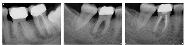 Figure 6: Apparent J-shaped lesion without a periodontal pocket; Figure 7A: Tooth No. 46 with a 10 mm pocket in the buccal furcation; Figure 7B: Six-month review of tooth No. 46