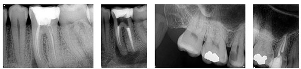 Figure 3A: Size 2 horizontal orientation; Figure 3B: Size 2 vertical orientation; Figure 4A: Periapical of tooth No. 15 using a size 2 sensor;Figure 4B: Periapical of tooth No. 15 using a size 1 sensor