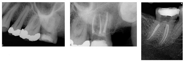 Figure 5A: Periapical of tooth No. 27 using a size 2 sensor; Figure 5B: Periapical of tooth No. 27 using a size 1 sensor; Figure 6: Slight change of horizontal angulation shows both mesial canals of tooth 46