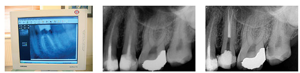 Figure 9: Digital image shown on a monitor; Figure 10A: Preoperative radiograph of tooth No. 25 using Schick CDR; Figure 10B: Postoperative radiograph of tooth No. 25 using Schick Elite