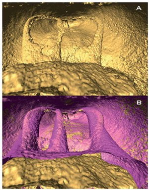 Figures 2A-2B: A. Three-dimensional reconstruction of a micro-computed tomographic scan of a mesial root of a mandibular first molar with three root canals before instrumentation (in yellow). B. Superimposition of pre- and post-instrumentation three-dimensional reconstructions (in pink postoperative) showing the centering ability of the reciprocating technique