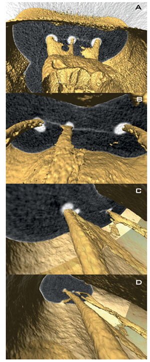 Figures 3A-3D: A. Three-dimensional reconstruction of a micro-computed tomographic scan of a mesial root of a mandibular first molar with three root canals before instrumentation (in yellow). Superimposition of preoperative three-dimensional reconstruction and postoperative bi-dimensional sections at coronal. B-C. Superimposition of preoperative three-dimensional reconstruction and postoperative bi-dimensional sections at coronal middle and apical level. D. Showing the modification of root canal anatomy and geometry induced by reciprocating instrumentation