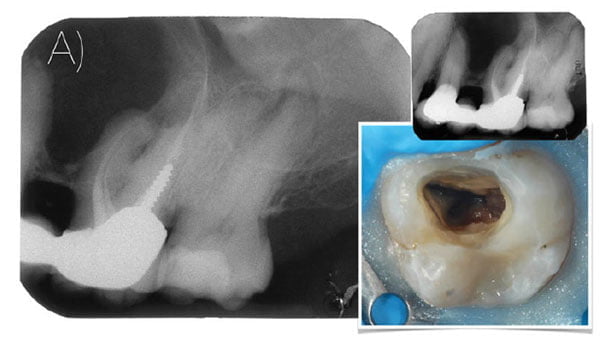 Figure 7A: Preoperative periodical radiograph of the upper left second molar with apical periodontitis