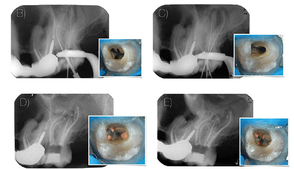 Figures 7B and 7C: Periapical radiograph of working length with manual stainless steel files. In MB2, it was impossible to negotiate the root canal with manual files; Figures 7D and 7E: Periapical radiographs at different horizontal angulation of the final obturation. The scouting and negotiation of the MB2 was made possible with the mechanical reciprocation scouting approach using R25