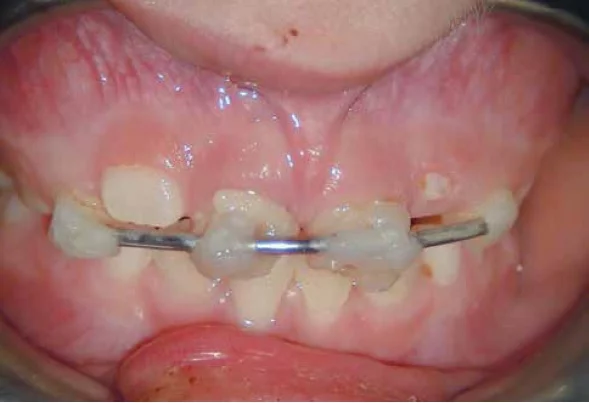 Figure 1: Clinical picture showing a rigid splint and crown fractures of teeth No. 8 and No. 9