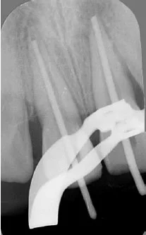 Figure 11: Radiograph showing cone fit