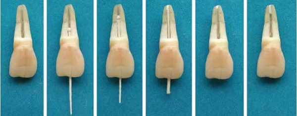 Figure 12: (Left to right) A demonstration of how a small piece of a bioceramic cement is tapped down the root canal using paper points Close to the apex, the paper point in this case (narrow canal) was no longer inverted. After the first portion of the cement is secured apically, more material can be added, depending on the overall treatment plan. Courtesy of Artendo Enterprises Inc. This image was previously published in an article by Haapasalo, et al., titled “Clinical use of bioceramic materials,” in Endodontic Topics, 2015; 32:97-117, and is re-used with permission of Dr. Markus Haapasalo. 