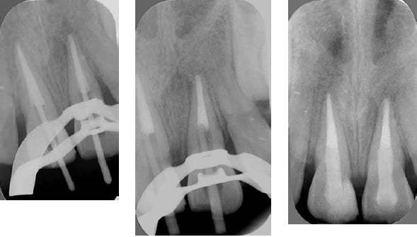 (L to r) Figure 13: EndoSequence RRM Putty has been applied as an apical plug, and the gutta-percha cones buttered with EndoSequence BC sealer have been placed Figure 14: Post space has been created in the coronal half of the root canals Figure 15: Postoperative radiograph showing the root-filled teeth restored with fiber posts and composite resin 