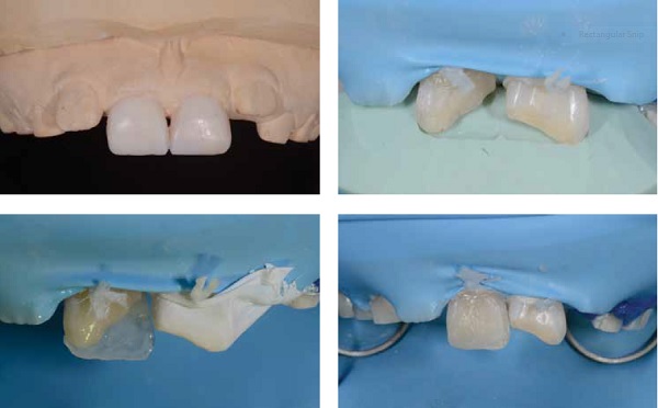 (L to r) Figures 17A-17D: Wax-up made in the laboratory. A putty mold made over the wax-up was used to build-up the composite restoration in different layers, starting with a palatal shell