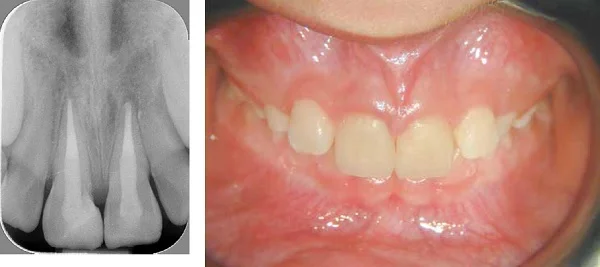 (L to r) Figure 19: At 20 months, the lesions have decreased in size, and the patient is asymptomatic Figure 20: Clinical picture at 20 months, showing two healthy central incisors in full function