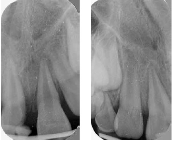 (L to r) Figure 2: Preoperative radiograph showing a crown-root fracture of tooth No. 8 and a widened PDL of tooth No. 9. Figure 3: Preoperative radiograph of teeth No. 7 and No. 8 showing a widened PDL of tooth No. 8 