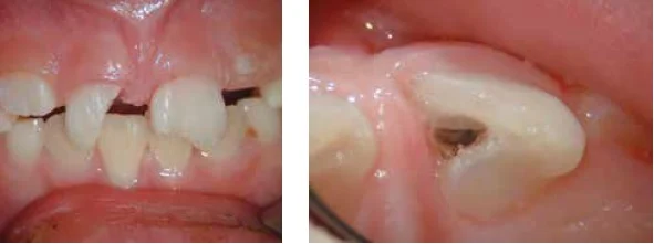 (L to r) Figure 4: After removal of the splint, the extent of the fractures is clearly visible Figure 5: A complicated crown-root fracture has been exposed to the oral environment for 2 weeks and has resulted in pulp necrosis 