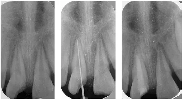 (L to r) Figure 6: Radiolucency associated with tooth No. 9 in conjunction with a positive pulp test Figure 7: A LightSpeed instrument is used to determine working length Figure 8: Inter-appointment dressing of calcium hydroxide and a temporary restoration