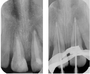 (L to r) Figure 9: Both central incisors are dressed with calcium hydroxide Figure 10: Gauging the apical foramen with LightSpeed instruments