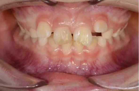 Figure 16: Clinical picture of a LuxaCore build-up in tooth No. 8 