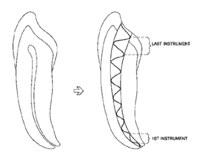 Figure 1B: A schematic demonstrating the enlargement root canal utilizing pre-curved instruments and employing Schilder’s strategy for creating the envelope of motion. Note that the first instruments are directed to toward the apical segment, while the last instruments are directed toward the orifice of the canal. The confluence of the prepared segments produces the continuously tapering shape characteristic of this technique