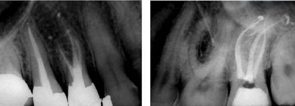 Figure 4: Postoperative radiograph of an upper first bicuspid with three canals. The mesial canals were prepared with files X1 and X2 only. The palatal canal was prepared with X1, X2, and X3. The canals were obturated using Schilder or warm gutta-percha technique (M. Scianamblo, San Rafael, California) Figure 5: A postoperative radiograph of an upper second molar with severely dilacerated canals. The mesial canals were prepared with files X1 and X2 only. The palatal canal was prepared with X1, X2, and X3. The mesial canals were obturated with Thermofil®, and the palatal canal was obturated using an X-3 gutta-percha cone (G. Barboni, Bologna, Italy)