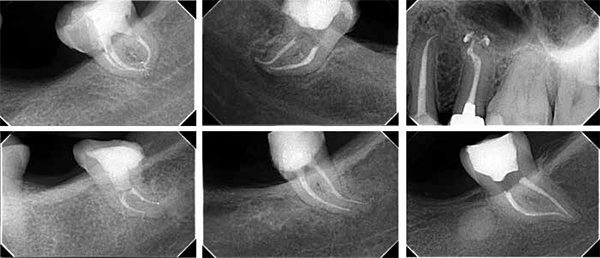 Figure 7: Instrumentation of challenging cases to larger apical preparations with tactile-controlled activation (TCA) and controlled-memory files
