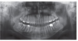 Figure 1: Abducent and inferior alveolar nerve injury due to endodontic overfill of mandibular molar (image courtesy of S. Ruggiero)