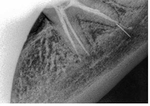 Figure 4: Panoral X-ray illustrating over-instrumentation of LL6 resulting in inferior alveolar nerve injury