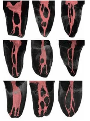 Figure 1: Anatomy of the canal system demonstrating accessory canals, fins and lateral canals that are not accessible with endodontic files as shown in cleared teeth